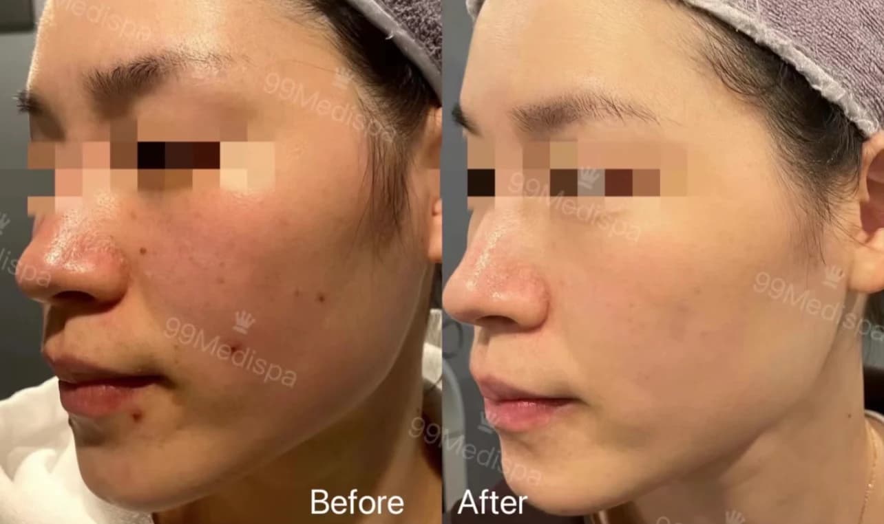 Picosure laser treatment result