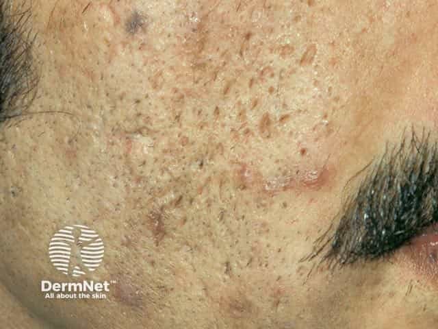 Acne scarring with post-inflammatory pigmentation on cheek