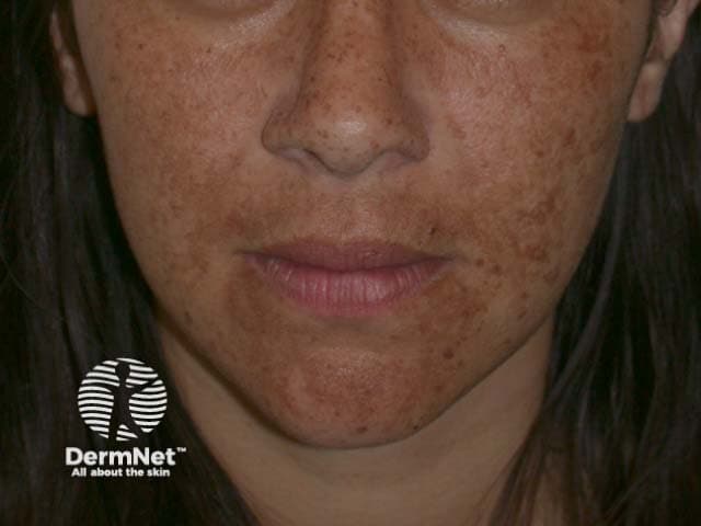 Melasma on face showing brown patches across cheeks and chin