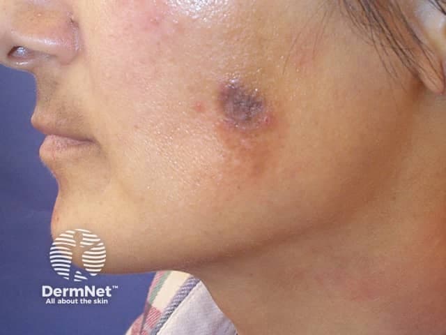 Post-inflammatory hyperpigmentation dark spot on face