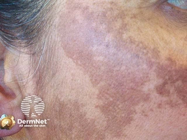 Chloasma pregnancy mask pigmentation on cheek