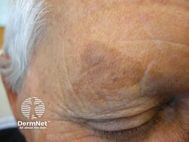 Solar lentigines sunspots on skin from UV damage