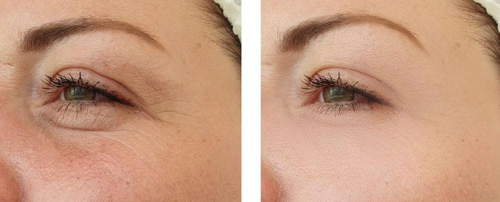 Before and after Rejuran eye treatment — under-eye fine lines and bags