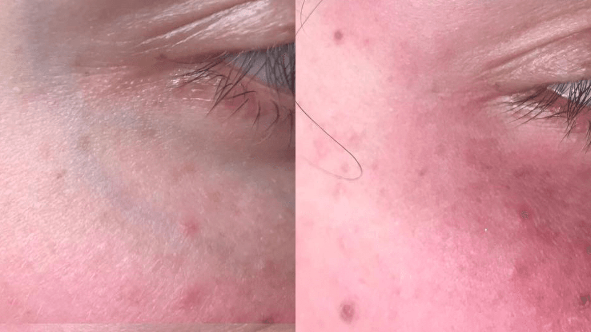 Before and after facial capillary treatment with Fotona Nd:YAG laser — eye area