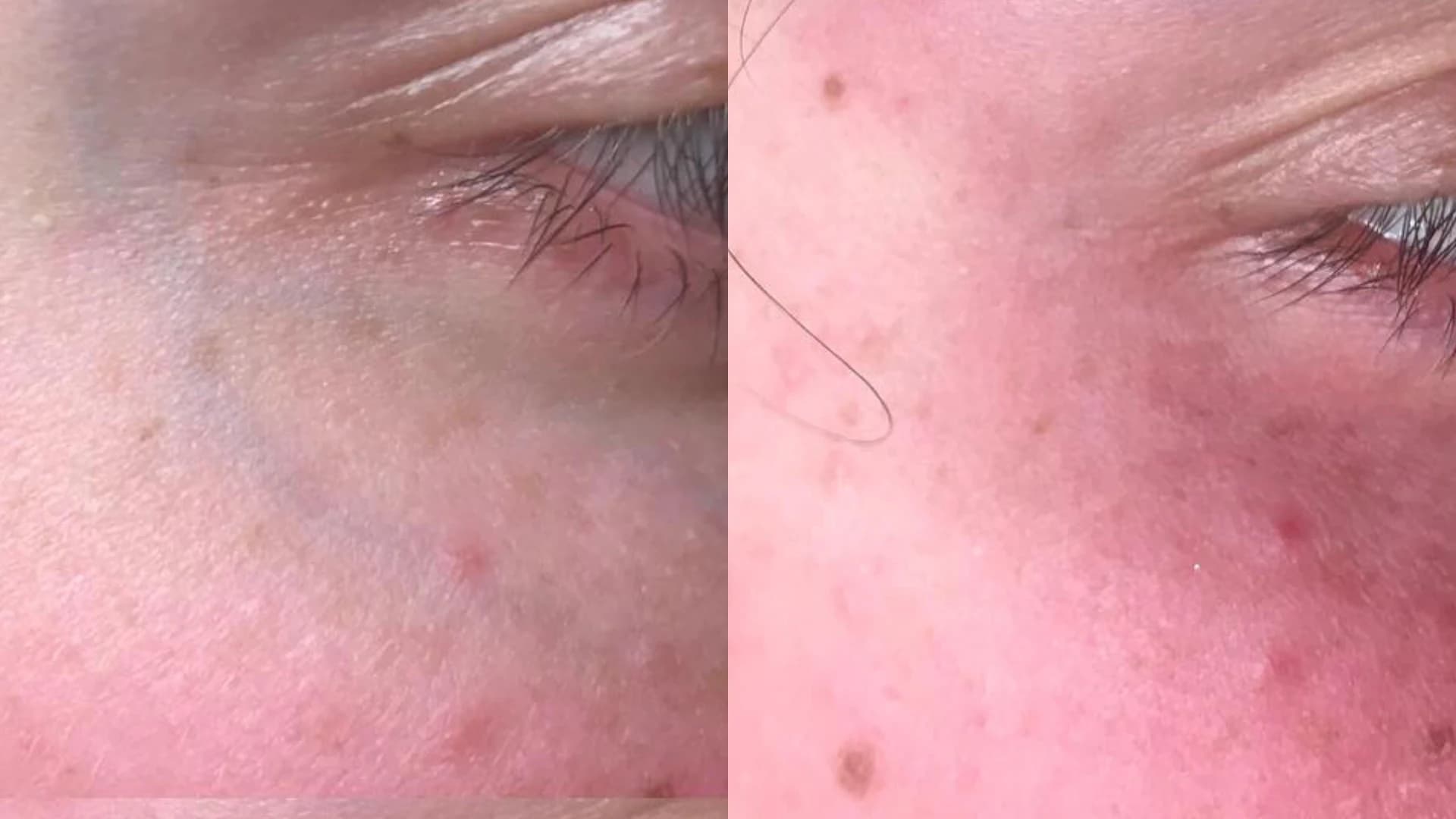 Before and after facial capillary treatment with Fotona Nd:YAG laser — eye area