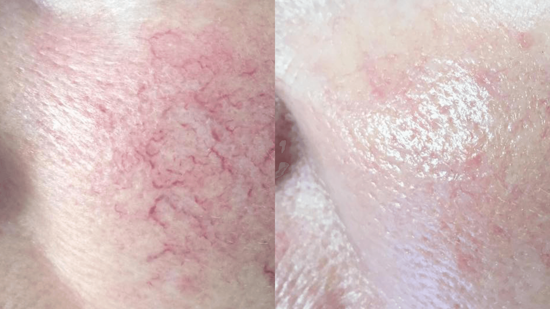 Before and after spider vein treatment with Fotona Nd:YAG laser — cheek