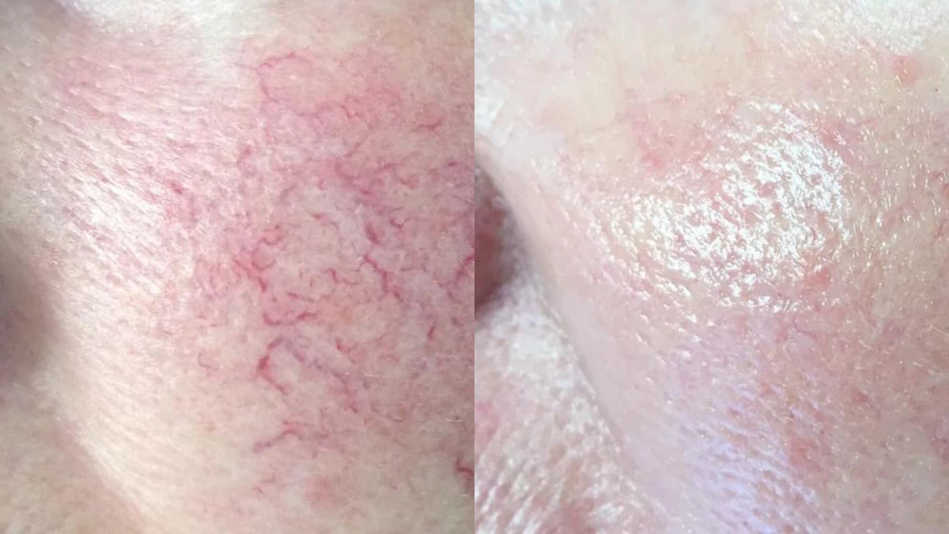 Before and after spider vein treatment with Fotona Nd:YAG laser — cheek