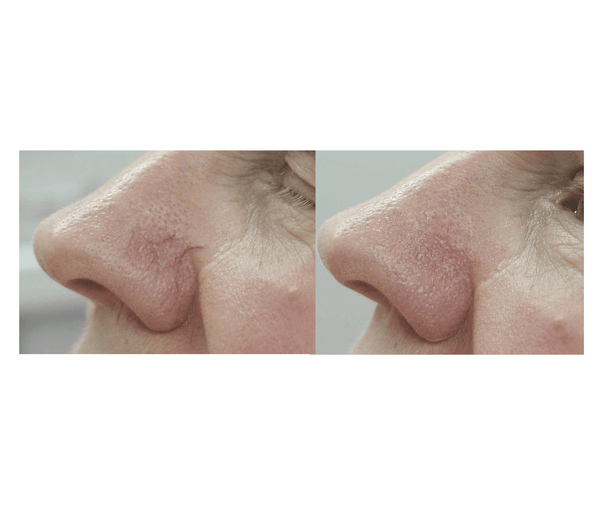 Before and after broken capillary treatment with Fotona Nd:YAG laser — nose