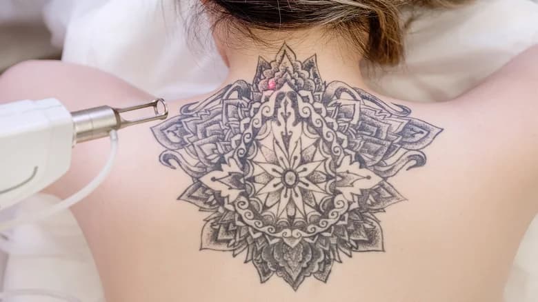 PicoSure laser tattoo removal