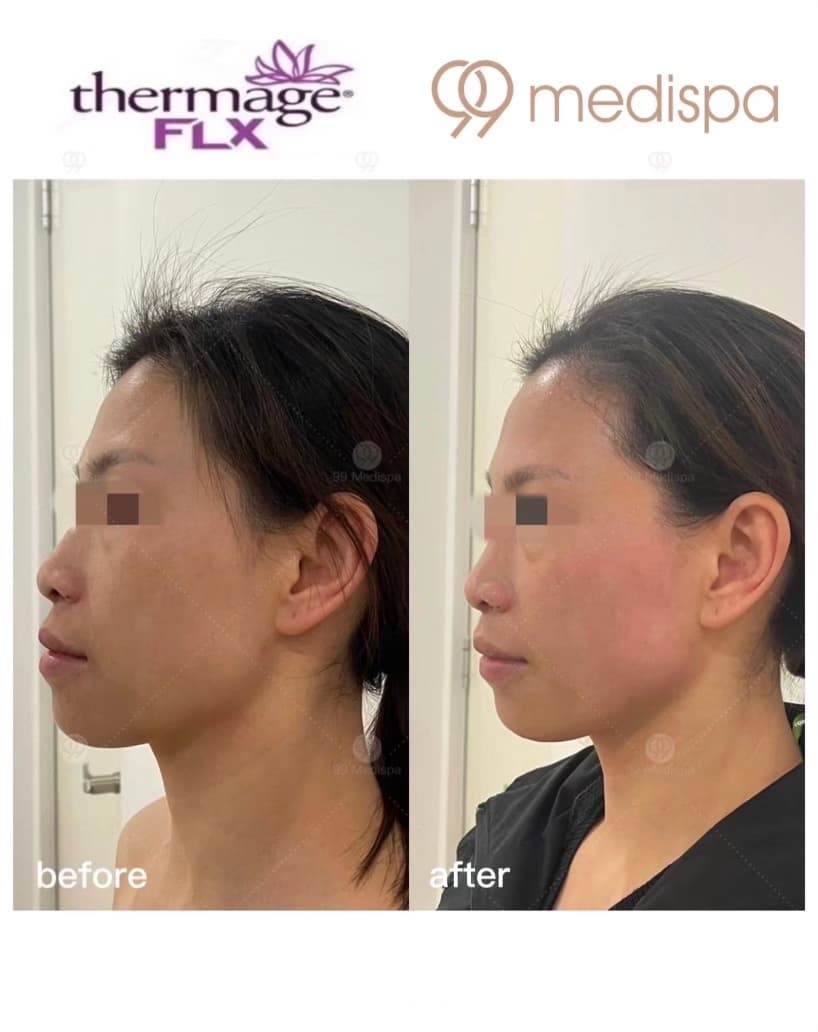 Before and after Thermage wrinkle treatment 1