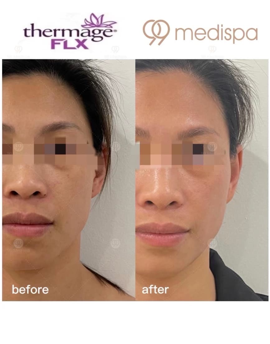 Before and after Thermage wrinkle treatment 2