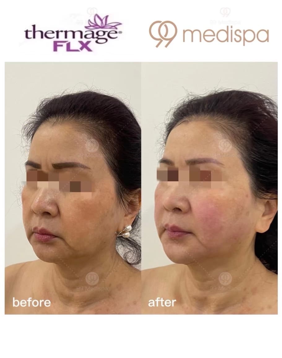 Before and after Thermage wrinkle treatment 3