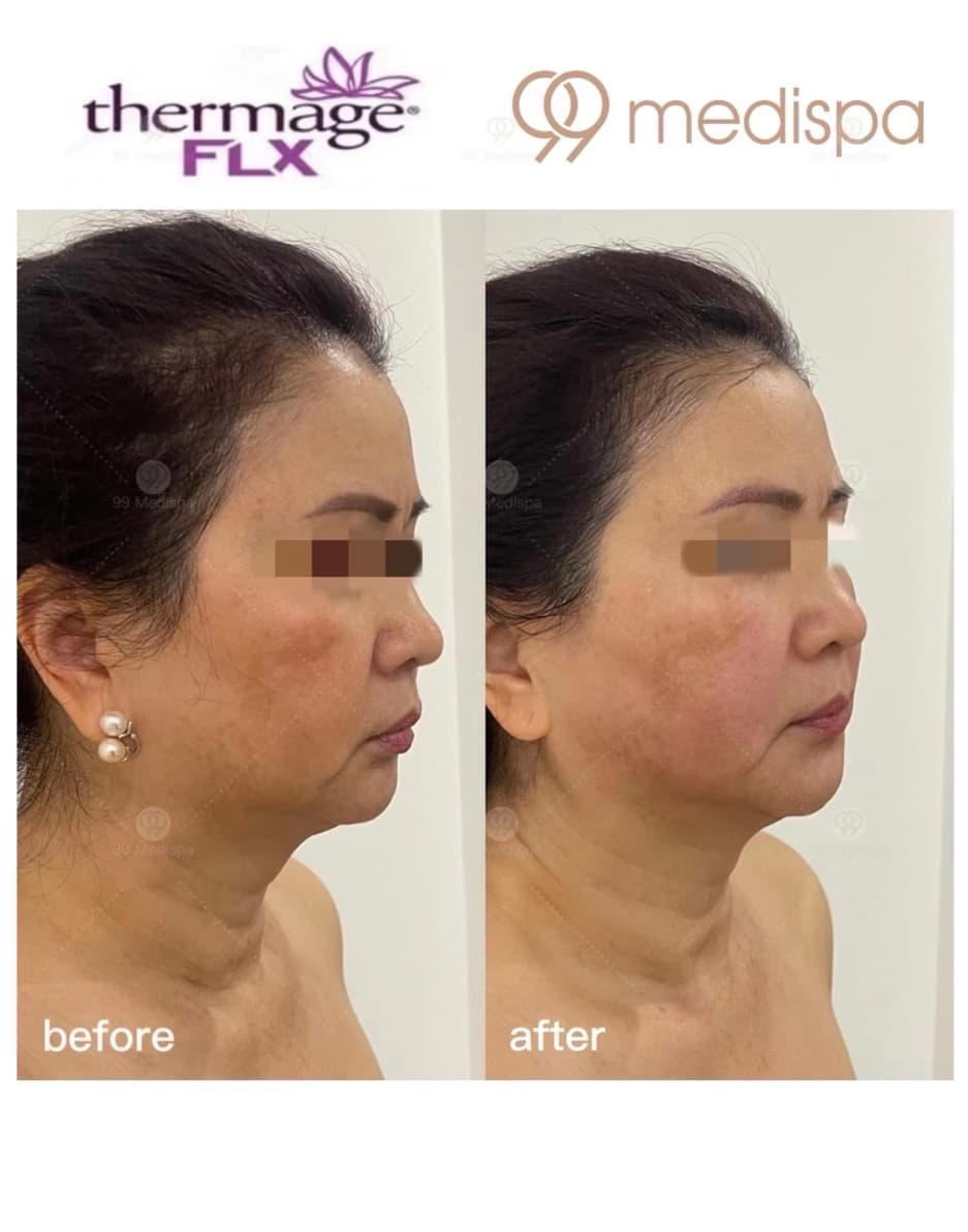 Before and after Thermage wrinkle treatment 4