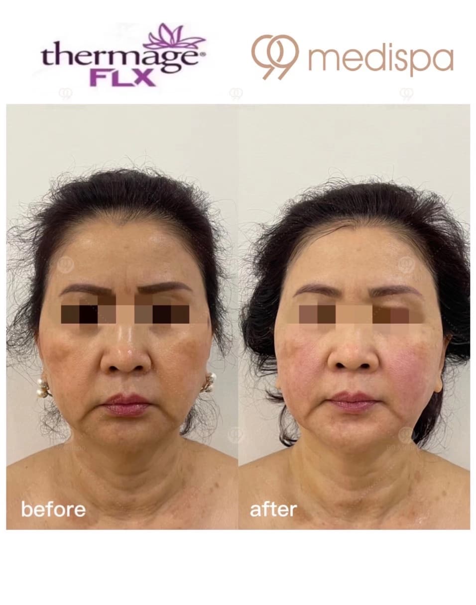 Before and after Thermage wrinkle treatment 5