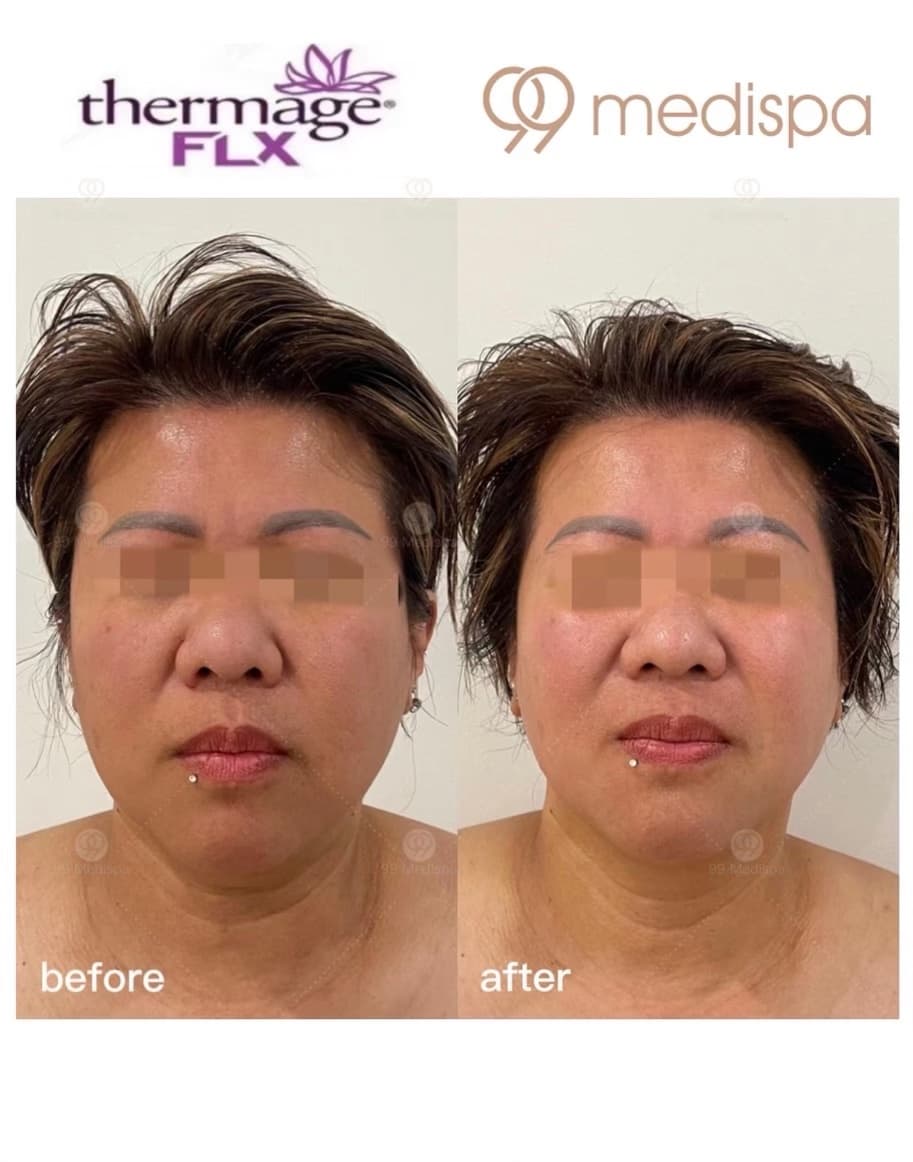 Before and after Thermage wrinkle treatment 6