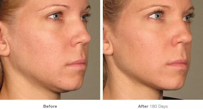 Before and after Ultherapy lifting result 1
