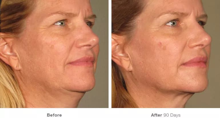 Before and after Ultherapy lifting result 10
