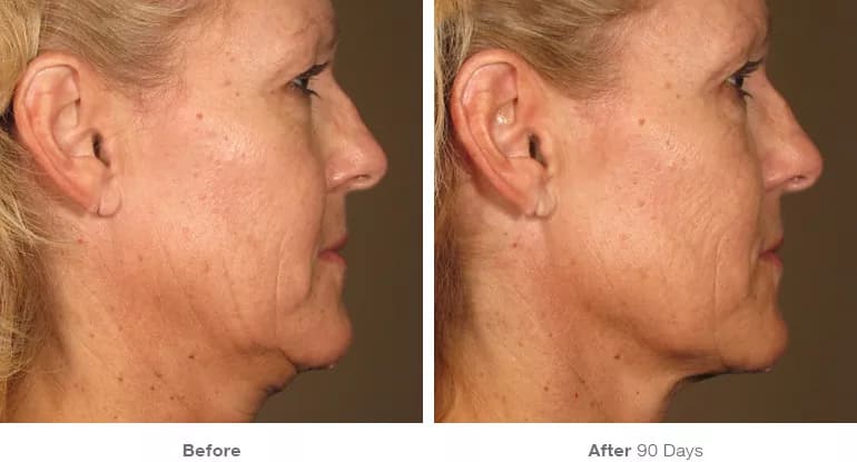 Before and after Ultherapy lifting result 2