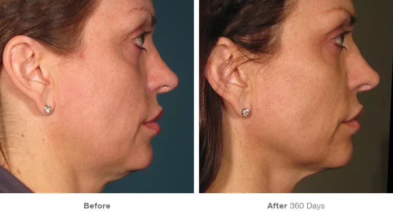 Before and after Ultherapy lifting result 3