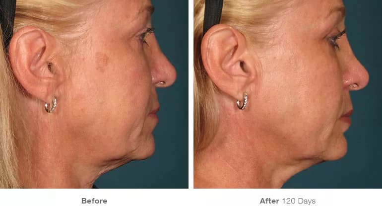 Before and after Ultherapy lifting result 4