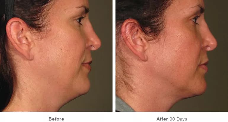 Before and after Ultherapy lifting result 5