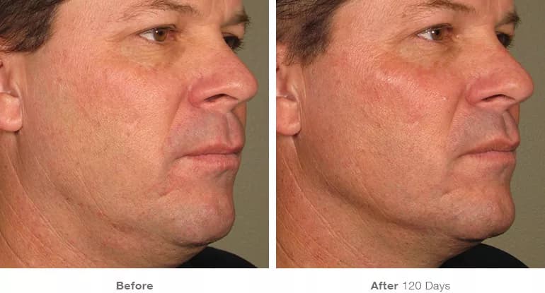 Before and after Ultherapy lifting result 6