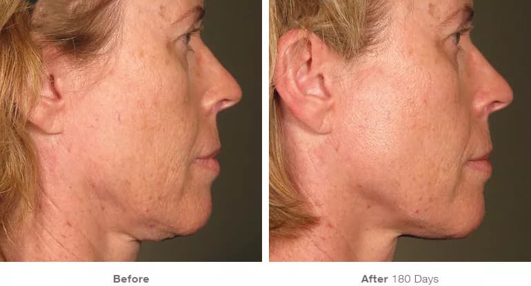 Before and after Ultherapy lifting result 7