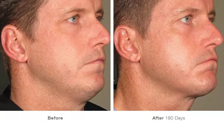 Before and after Ultherapy lifting result 8