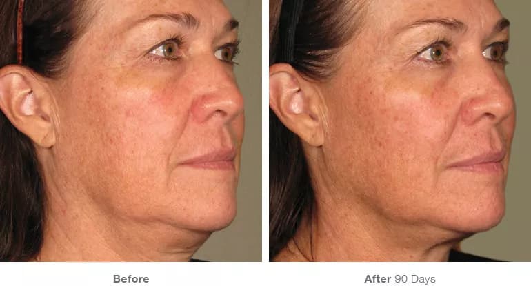 Before and after Ultherapy lifting result 9