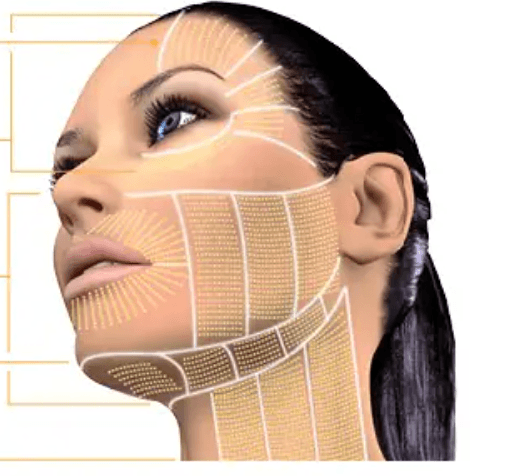 Ultherapy SMAS targeting diagram for jowl lifting