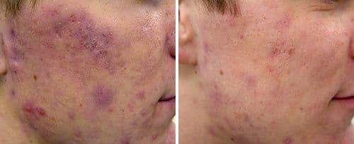 Twinlight Acne 治疗前后 — 活跃痘痘改善