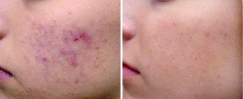 Twinlight Acne 治疗前后 — 肌肤更清透