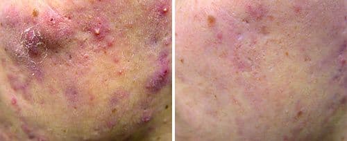 Twinlight Acne 治疗前后 — 爆痘减少