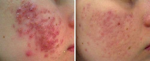 Twinlight Acne 治疗前后 — 炎症泛红减轻