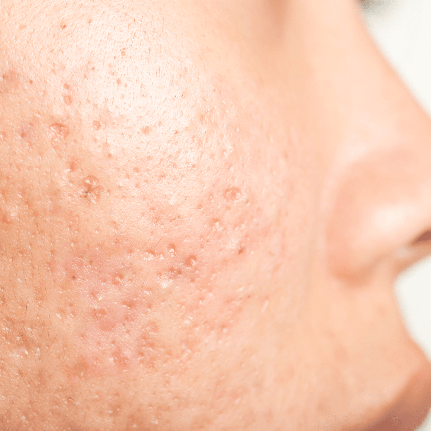 Before and after acne scarring treatment results showing improved skin texture and reduced scarring