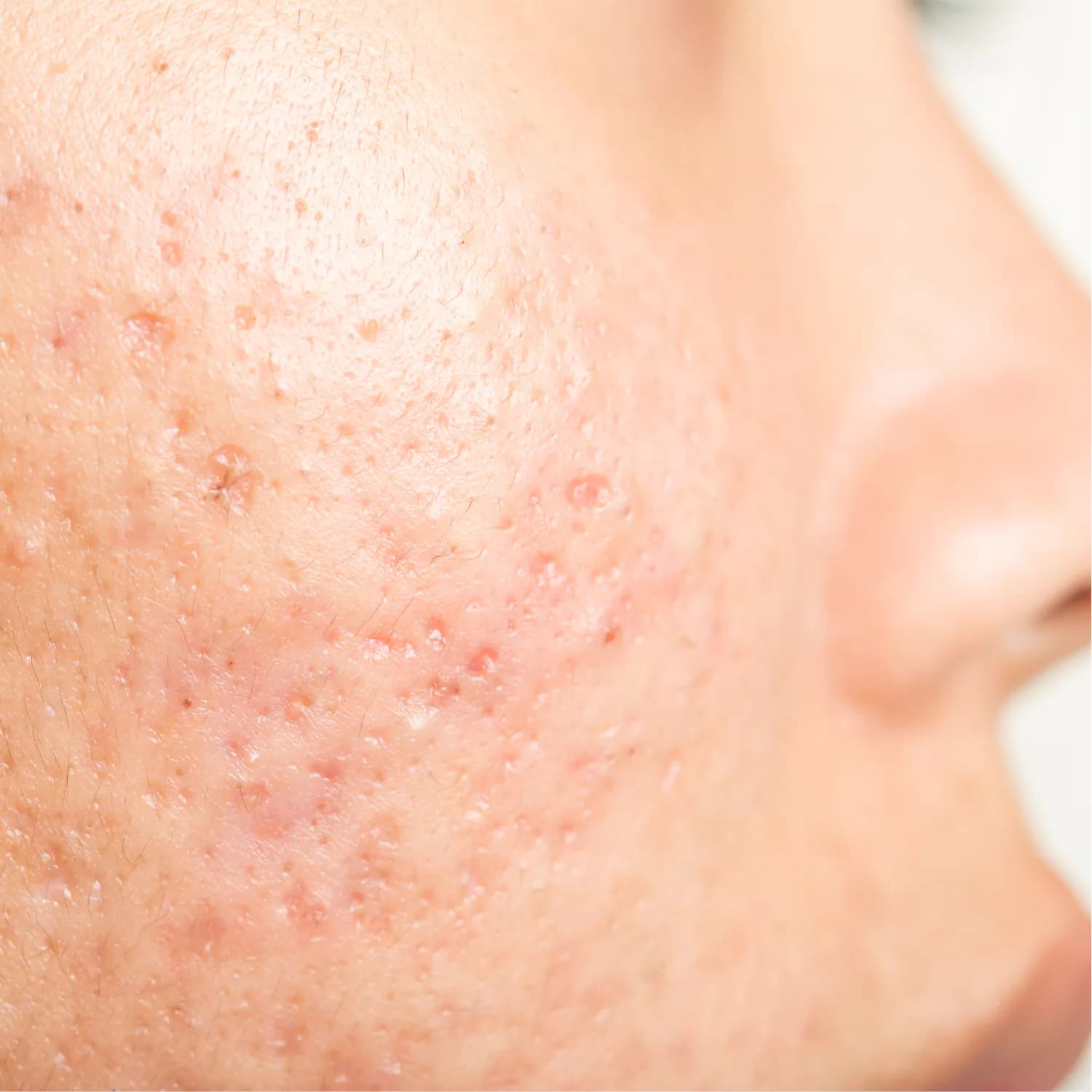 Close view of skin texture for an acne scar treatment consultation