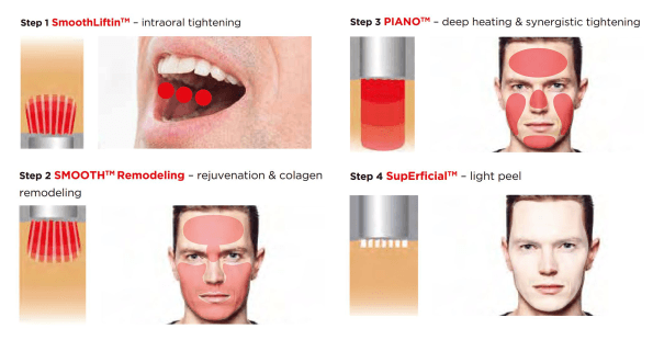 Four-step Fotona 4D diagram: SmoothLiftin intraoral tightening, SMOOTH remodelling, PIANO deep heating and SupErficial light peel, with the treated zones shaded on the face
