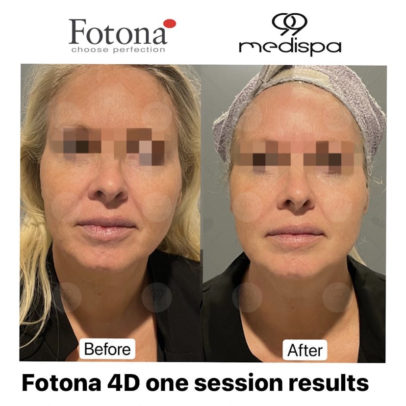 Before and after photo of Fotona treatment
