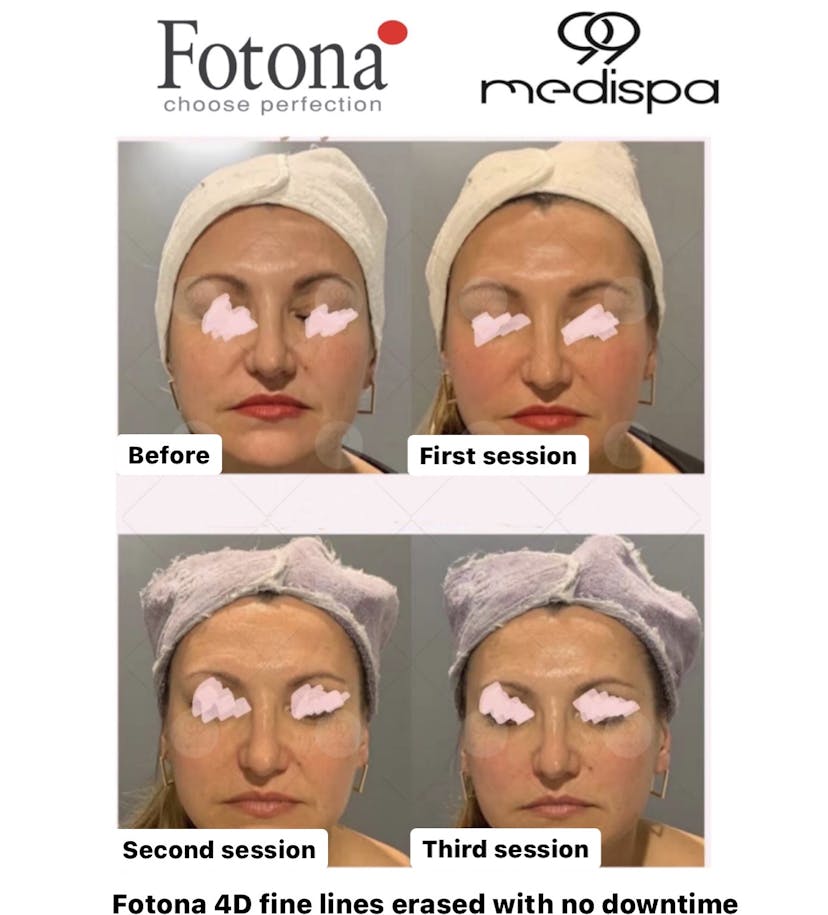 Before and after photo of Fotona treatment