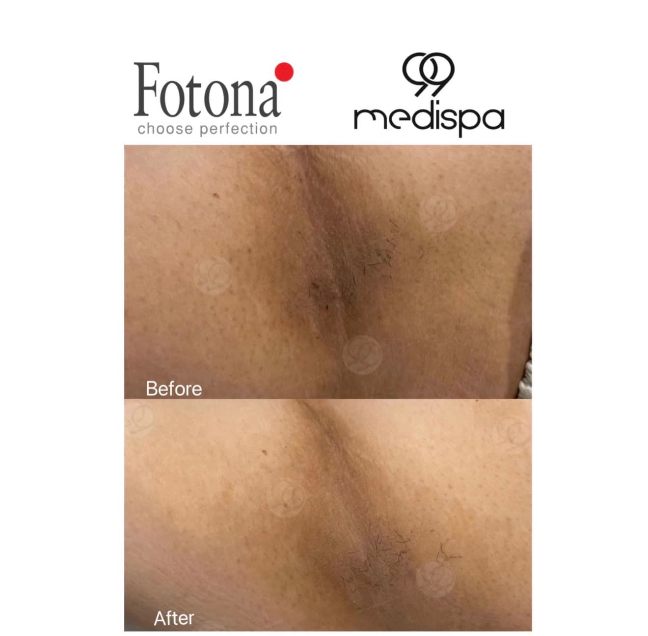 Underarm lightening comparison after 2 sessions