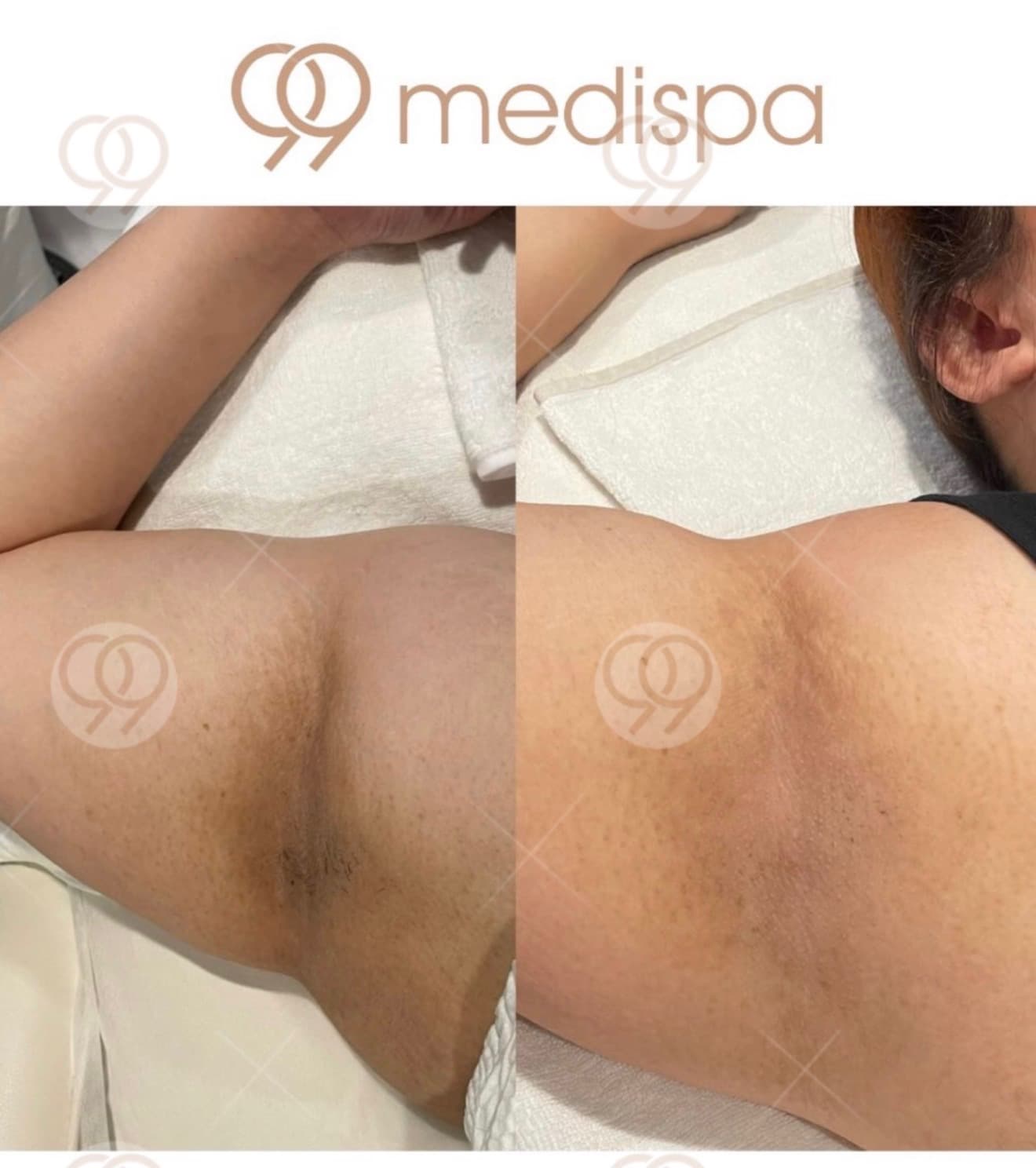 Underarm lightening comparison after 3 sessions