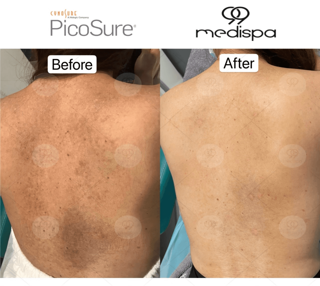 Before and after PicoSure pigmentation treatment result