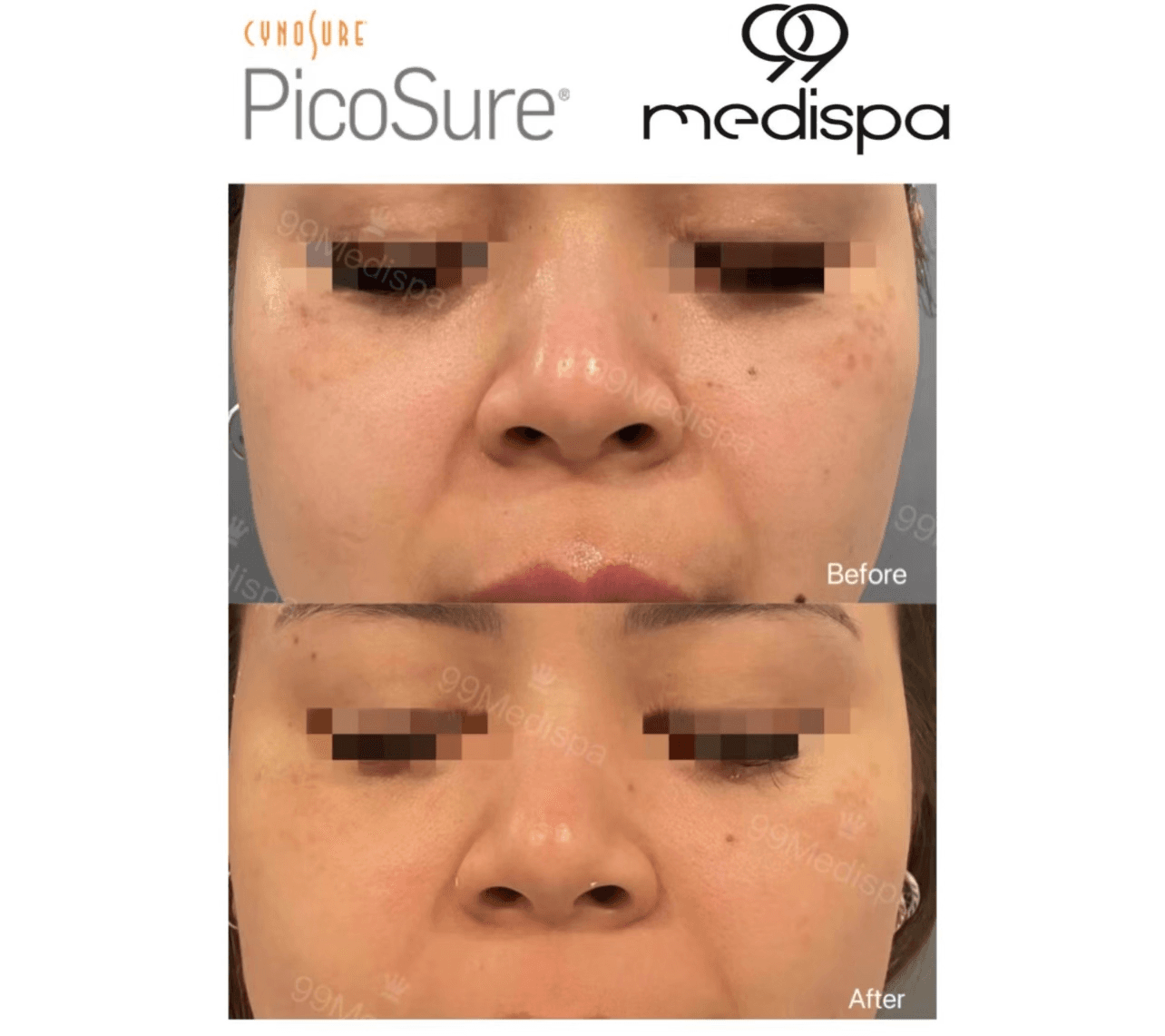 Laser pigmentation removal before and after result