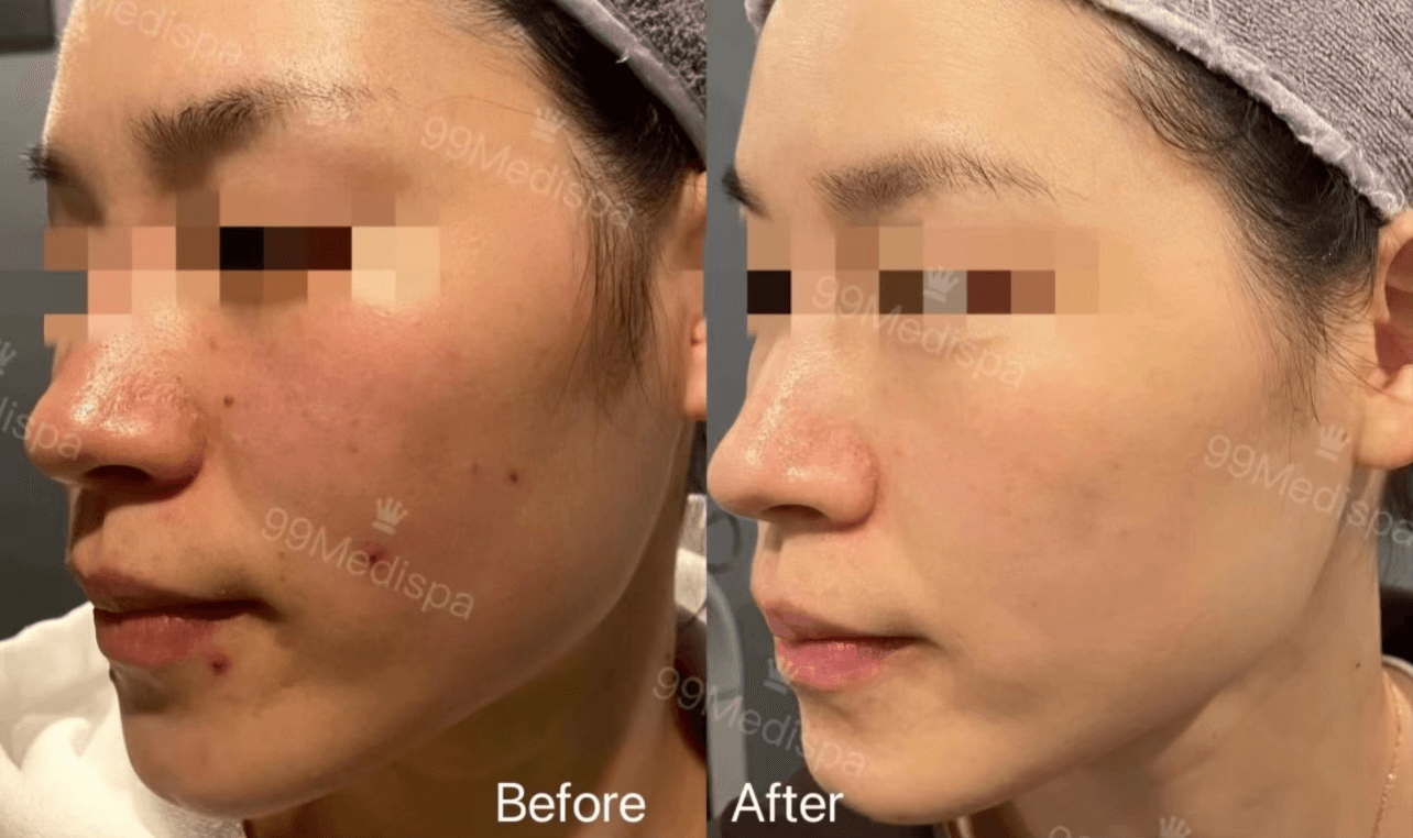 PicoSure treatment result for uneven pigmentation