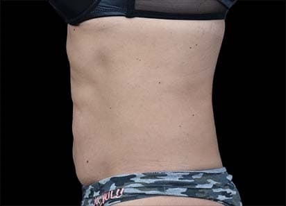 EMSCULPT before and after results - female abdomen transformation - After