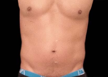 EMSCULPT before and after results - male abdomen transformation - Before