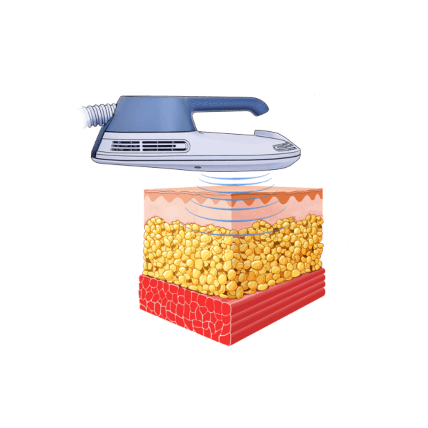 How EMSCULPT works - electromagnetic muscle stimulation for body sculpting