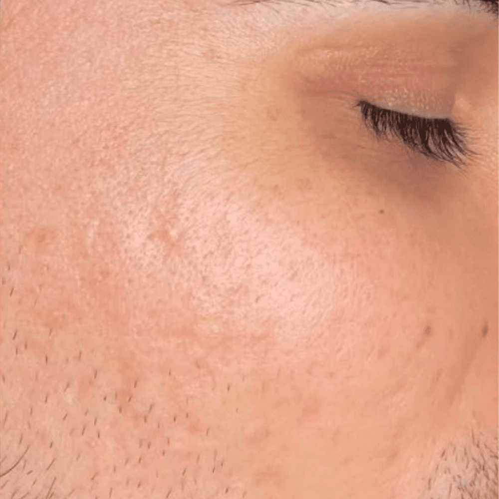 Rejuran before and after results 2 - After