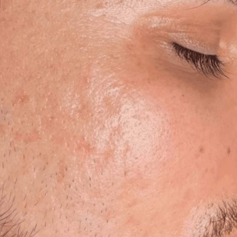 Rejuran before and after results 2 - Before