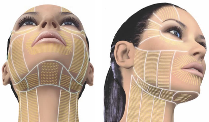 标示于面部与颈部的 Ultherapy 治疗部位